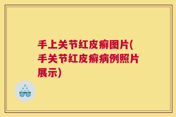 手上关节红皮癣图片(手关节红皮癣病例照片展示)